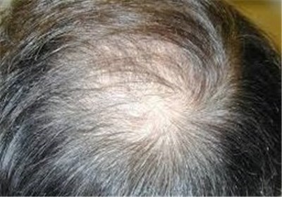 ریزش موی زنان نشانه این بیماری خطرناک است 