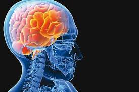 سردردی که منجر به سکته‌های مغزی می‌شود